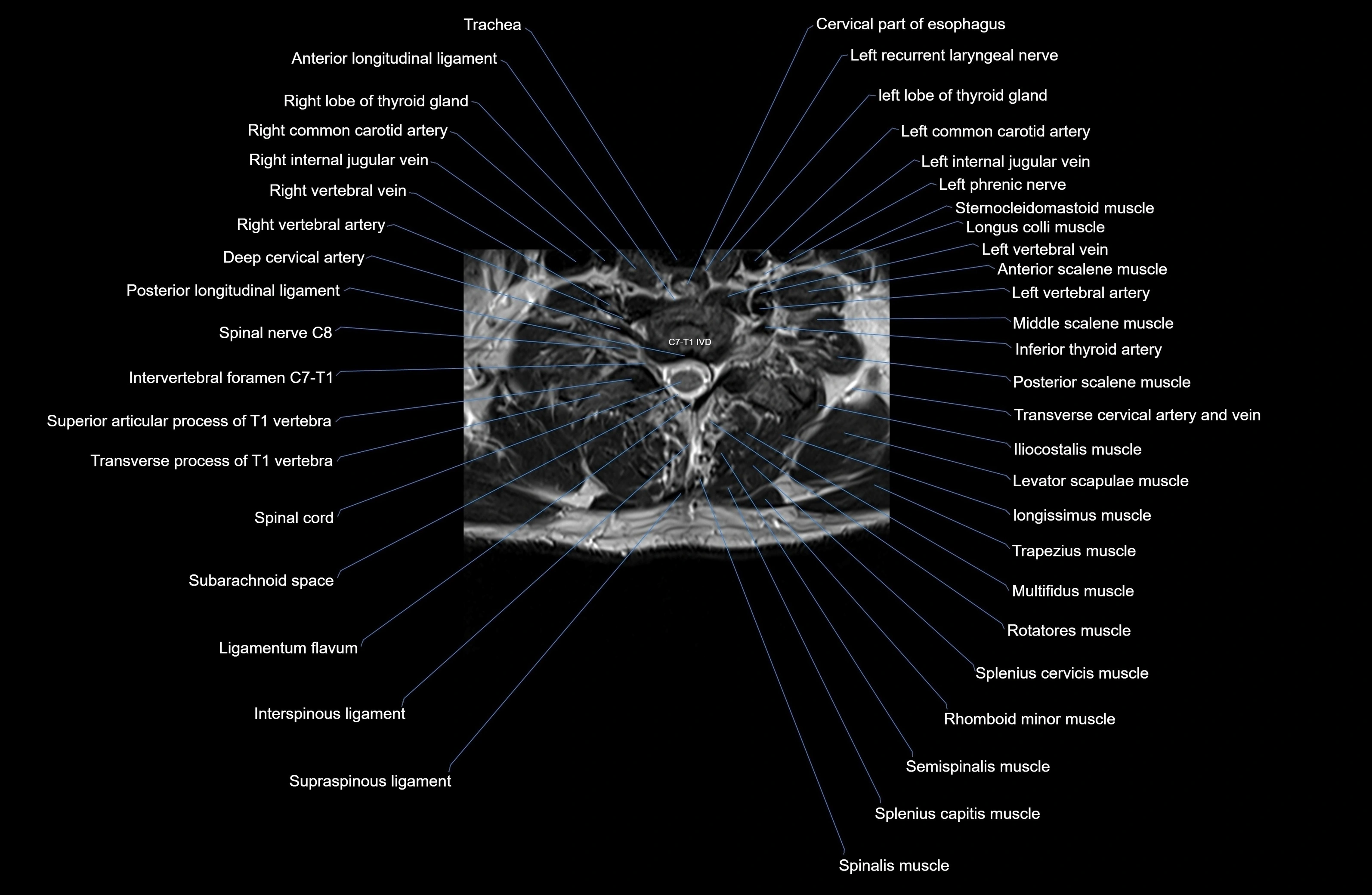 MRI thoracic spine axial  cross sectional anatomy 3T radiology  image-img-00001-00006.webp